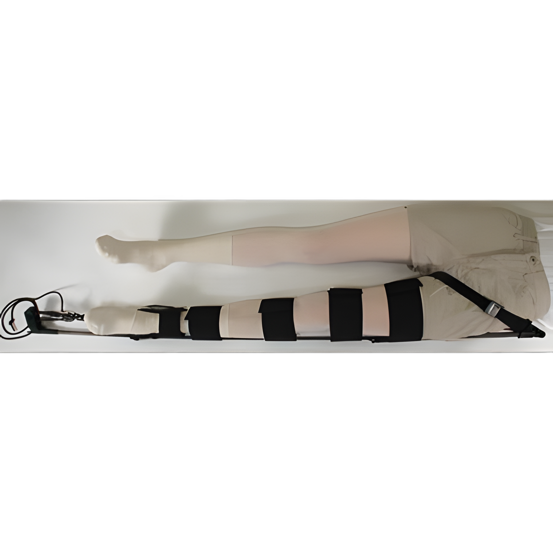 Traction Splint CT-6 Civilian Version One Size Fits Most Left or Right Leg