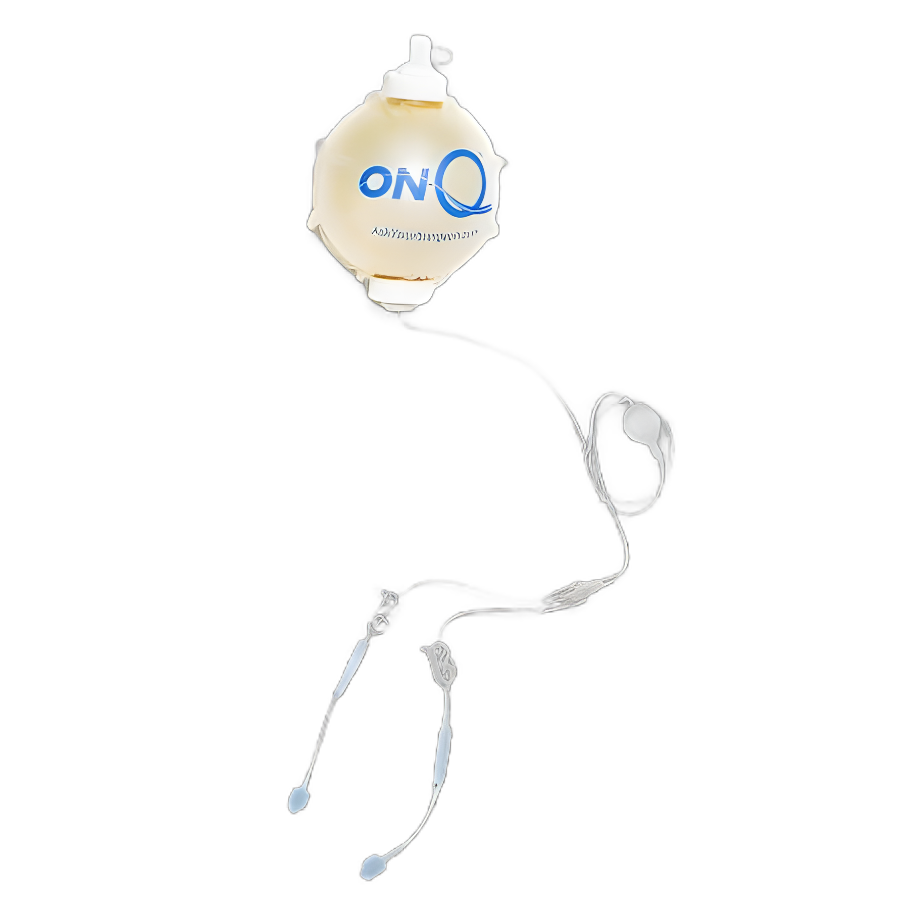 ON-Q* Gravity Elastomeric Pump for Effective Pain Management - 270 mL