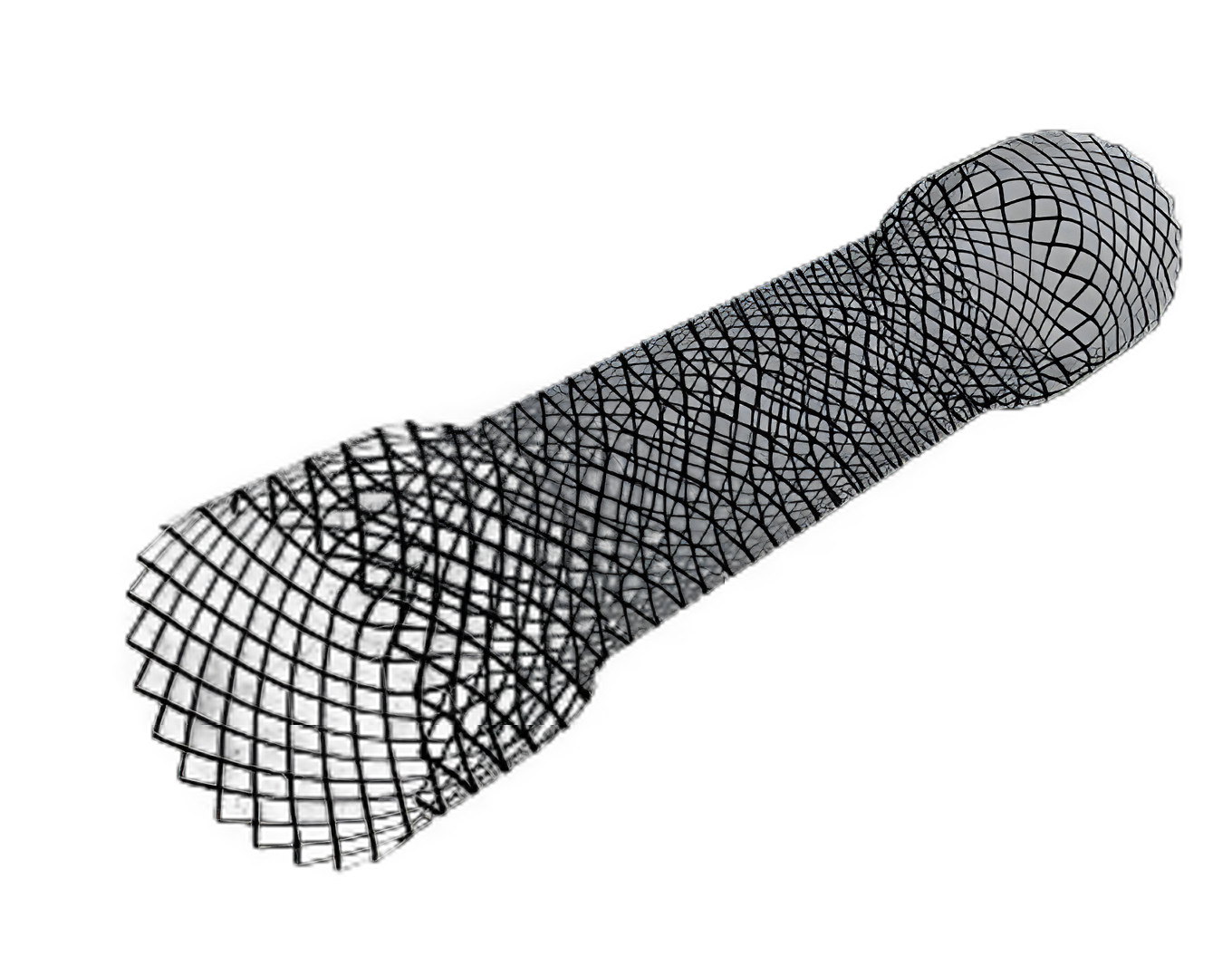 Duodenal Stent Evolution® 9 cm Nitinol by Cook Medical for Malignant Obstructions