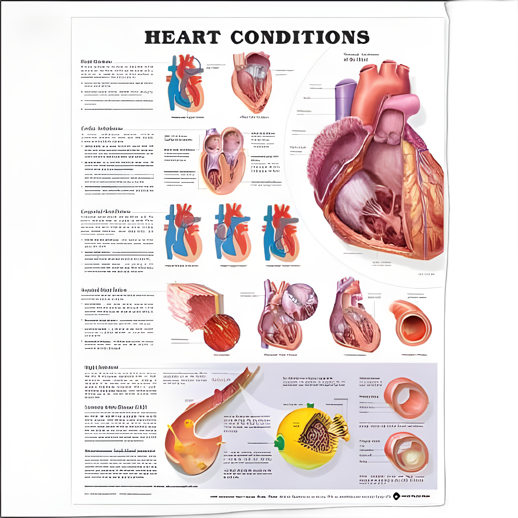 Anatomical Chart Heart Conditions 20 X 26 Inch Heavy Paper Laminated - 9781587798825