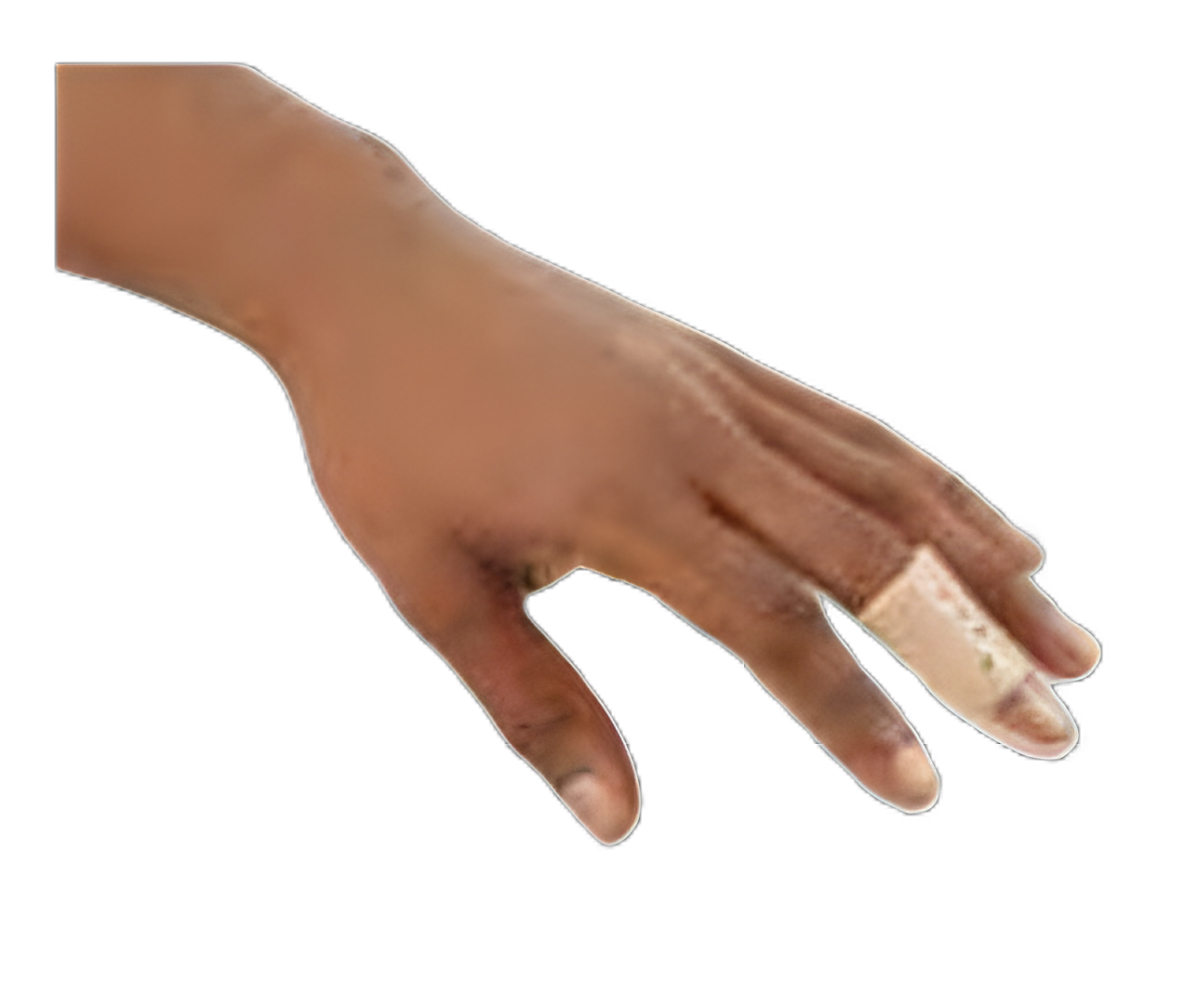 Breg® Stack Finger Splint Kit for Adults - Sizes 1 to 7, Cream Color