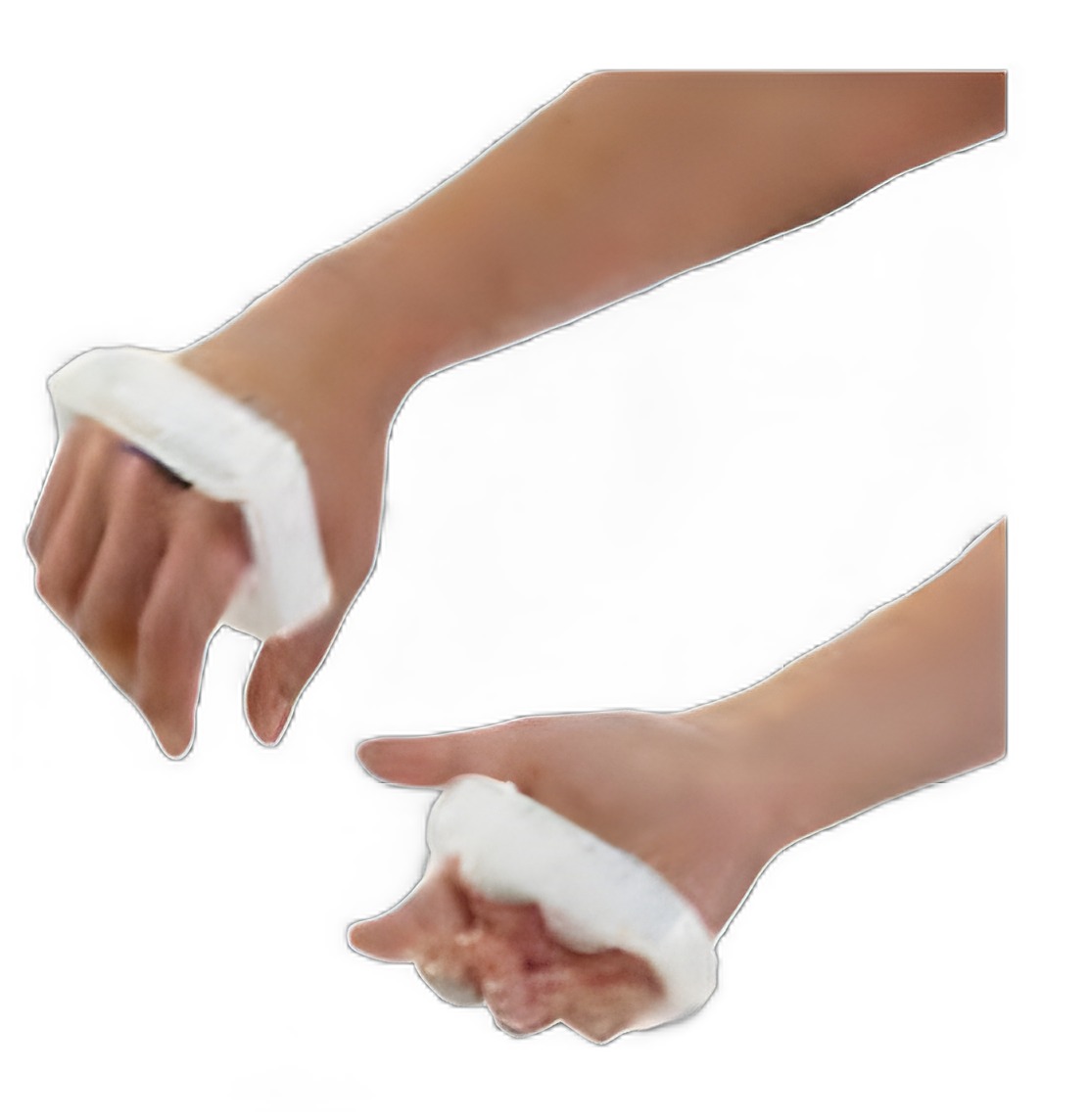 Breg Galveston Metacarpal Hand Splint - HDPE/Nylon/Polypropylene, Left/Right, Large