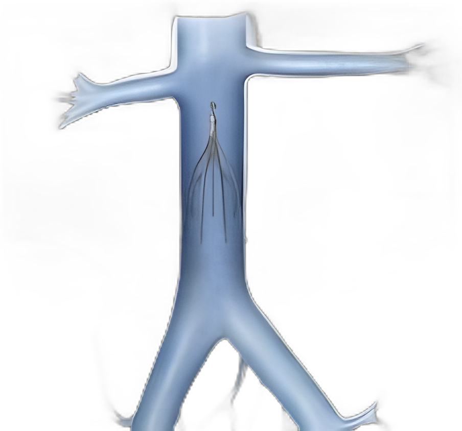 Platinum Vena Cava Filter Celect by Cook Medical - Advanced Pulmonary Embolism Prevention