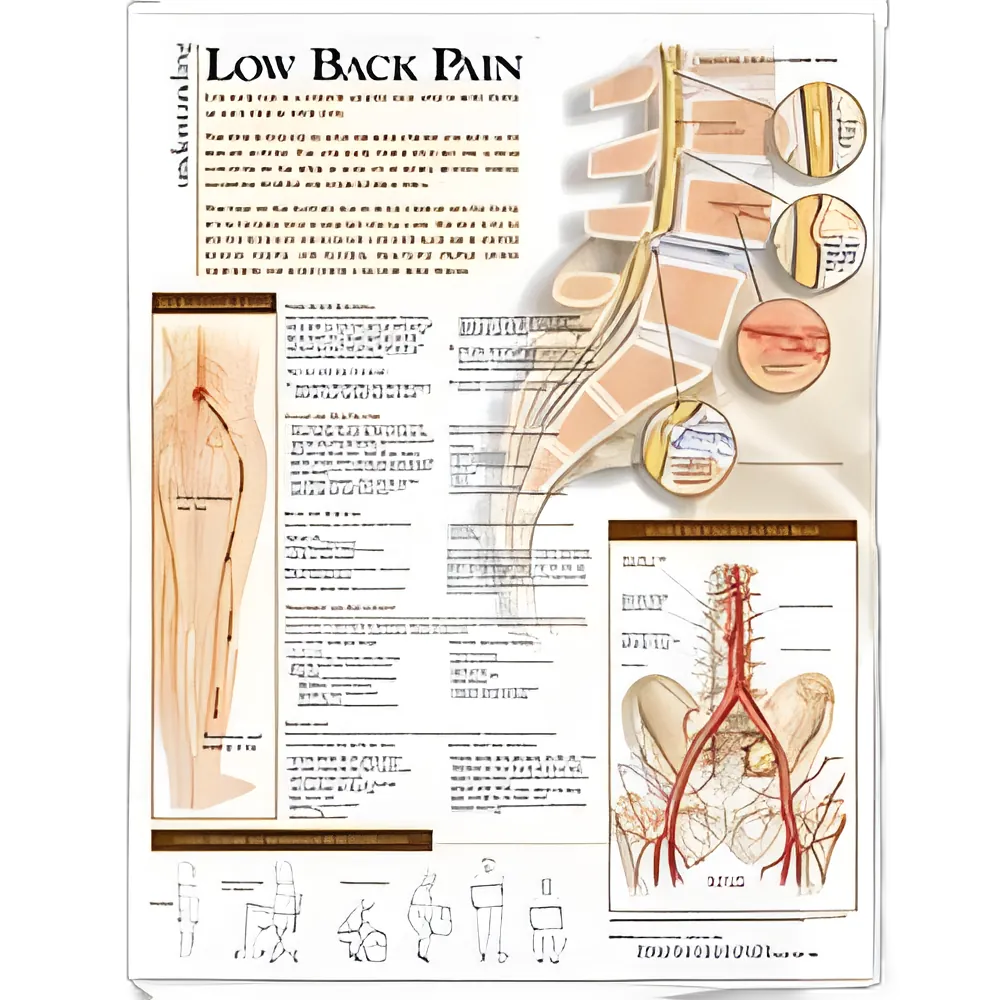 Anatomical Chart Understanding Low Back Pain 20 X 26 Inch Heavy Paper Grommets Laminated