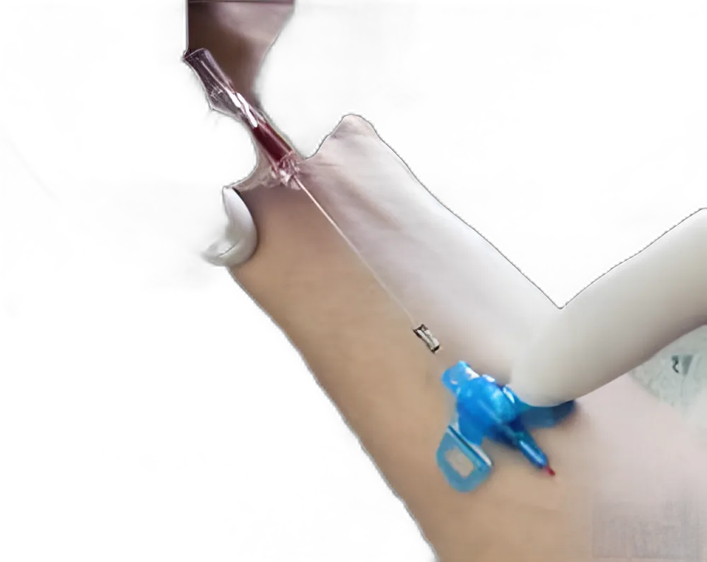 Closed IV Catheter Introcan Safety® 3 20 Gauge 1 Inch Sliding Safety Needle