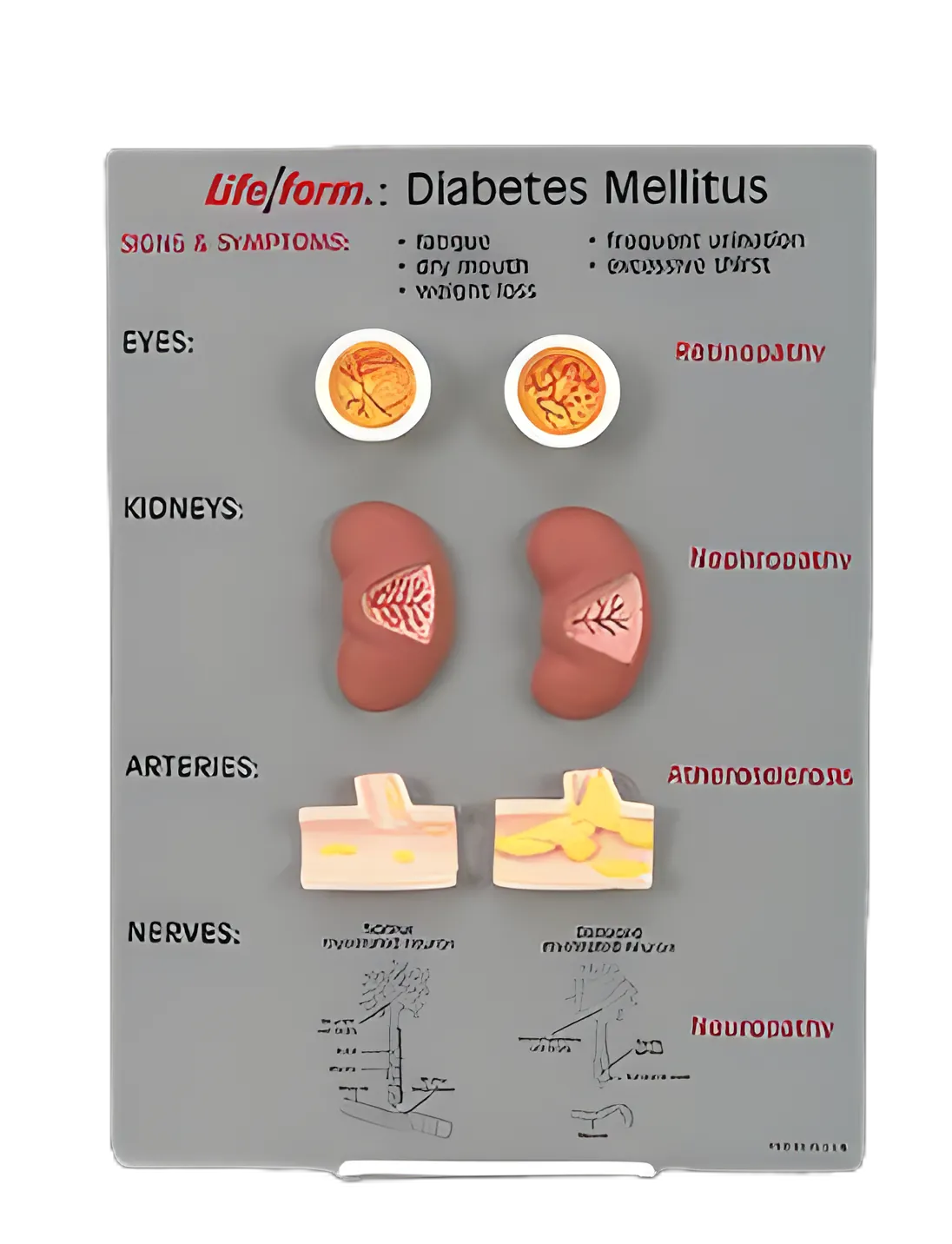 Life/form® Diabetes Mellitus Teaching Kit - Educational Model for Diabetes Awareness