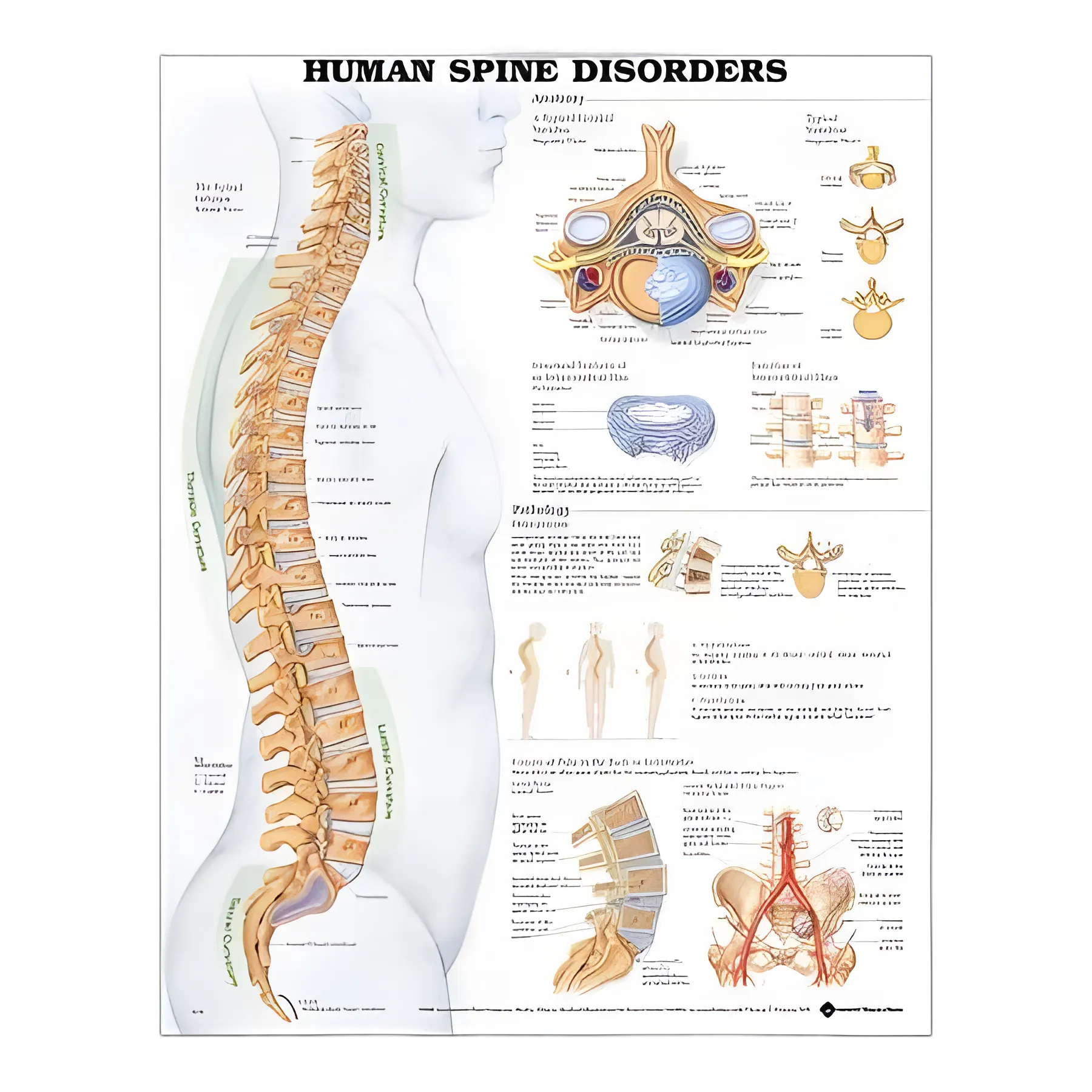 Anatomical Chart Human Spine Disorders 20 X 26 Inch Plastic Wall Mount Laminated