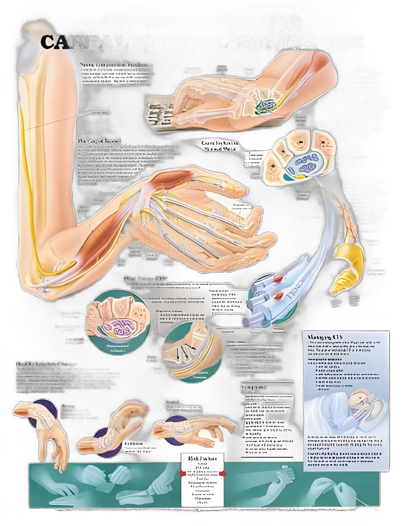 Anatomical Chart Understanding Carpal Tunnel Syndrome 20 X 26 Inch Heavy Paper Grommets Laminated