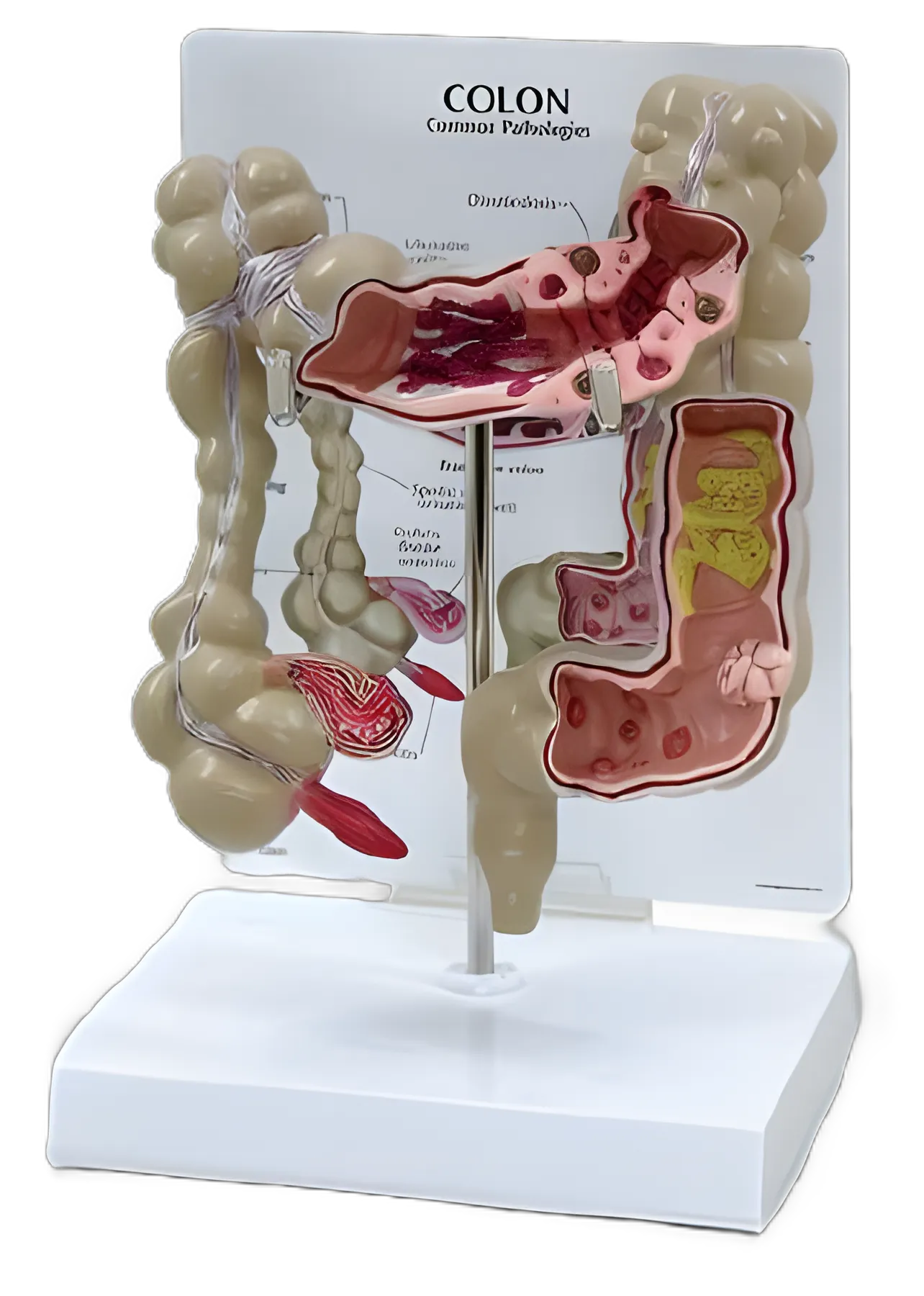 Nasco Colon Model with Pathologies for Medical Education