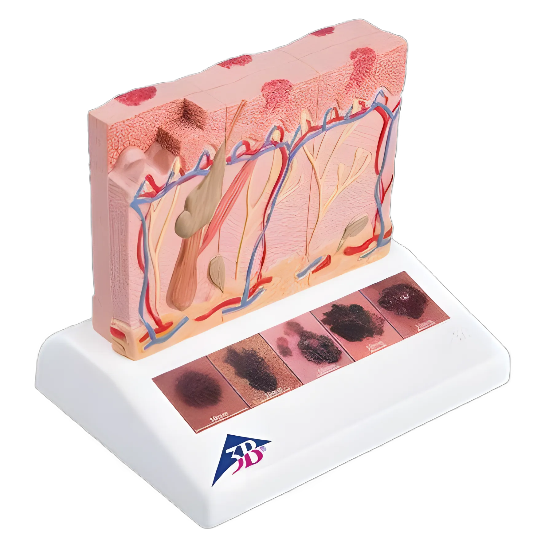 3B Scientific® Skin Cancer Model - Malignant Melanoma Stages Educational Tool, 0.44 lbs